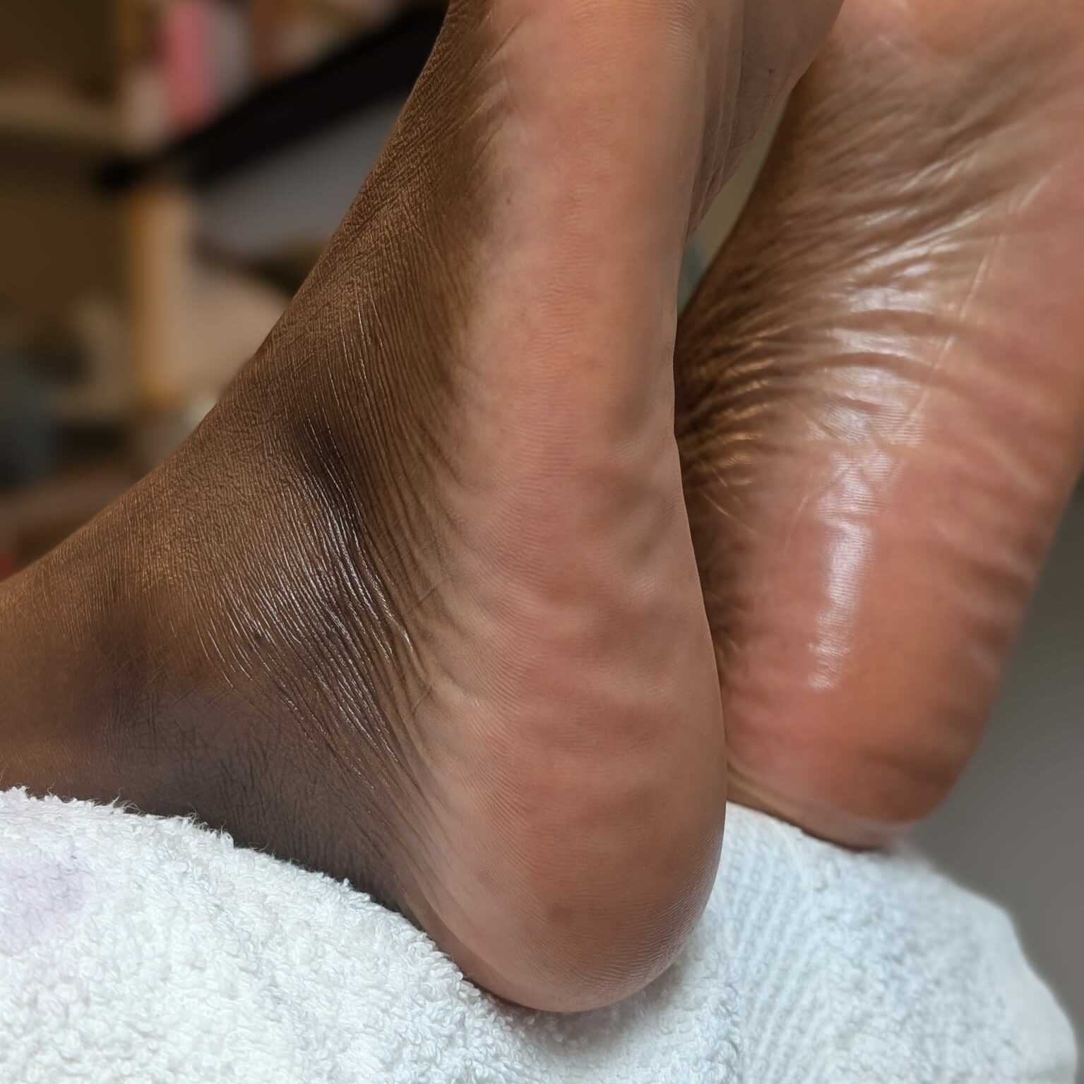 Callus peel