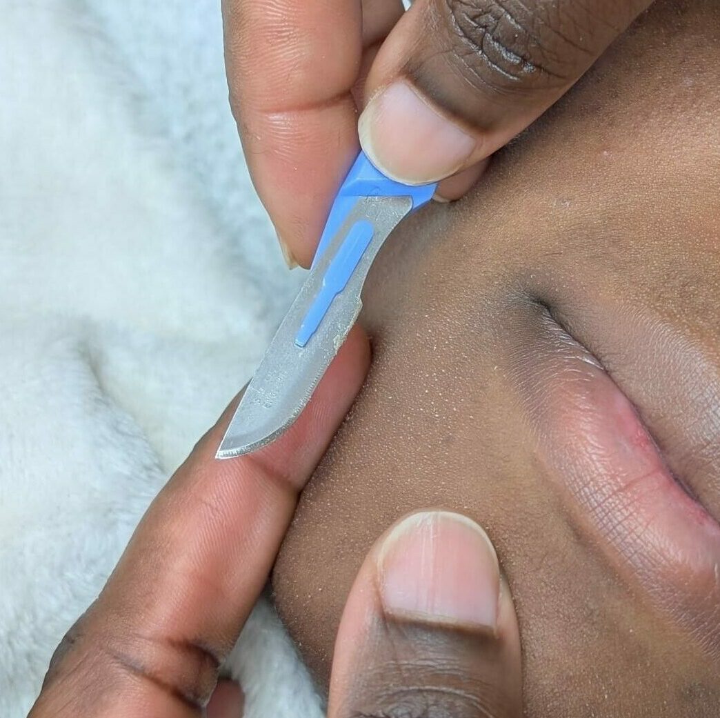 Dermaplaning